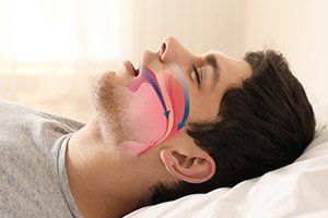 Man sleeping with airway animation over profile